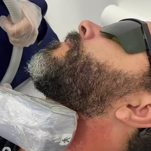 Depilação a laser masculina