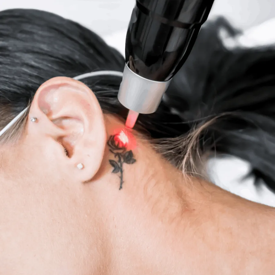 Remoção de Tatuagem